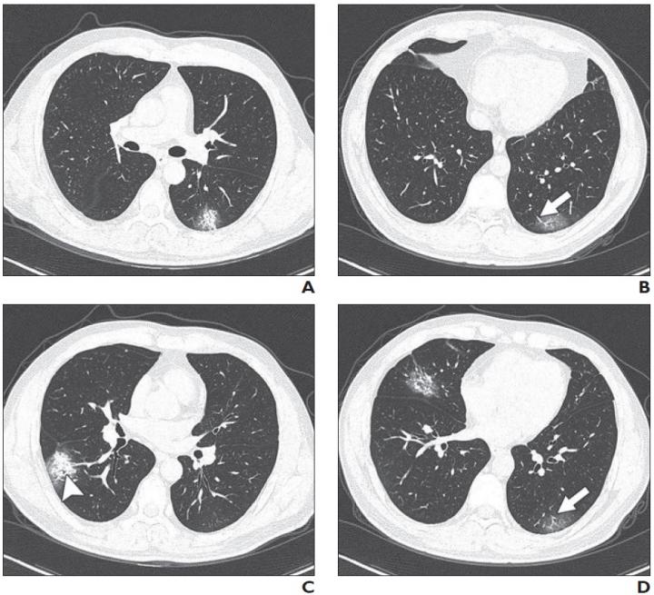 Patient had short-term exposure history to Wuhan and onset symptoms of fever (38°C) and cough. CT was performed on day of admission. A-D, CT images show bilateral multifocal ground-glass opacities (GGO) and mixed GGO and consolidation lesions. Traction bronchiectasis (arrowhead, C) and vascular enlargement (arrow, B and D) are also present. CT involvement score is 5. (Photo: American Journal of Roentgenology (AJR))